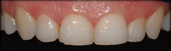 Implantes Dentales Mallorca